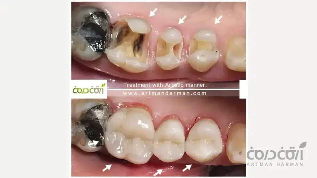 بیلداپ دندان