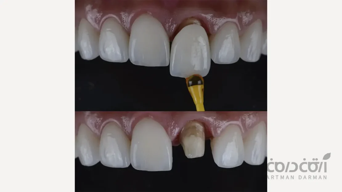 روکش دندان جلو