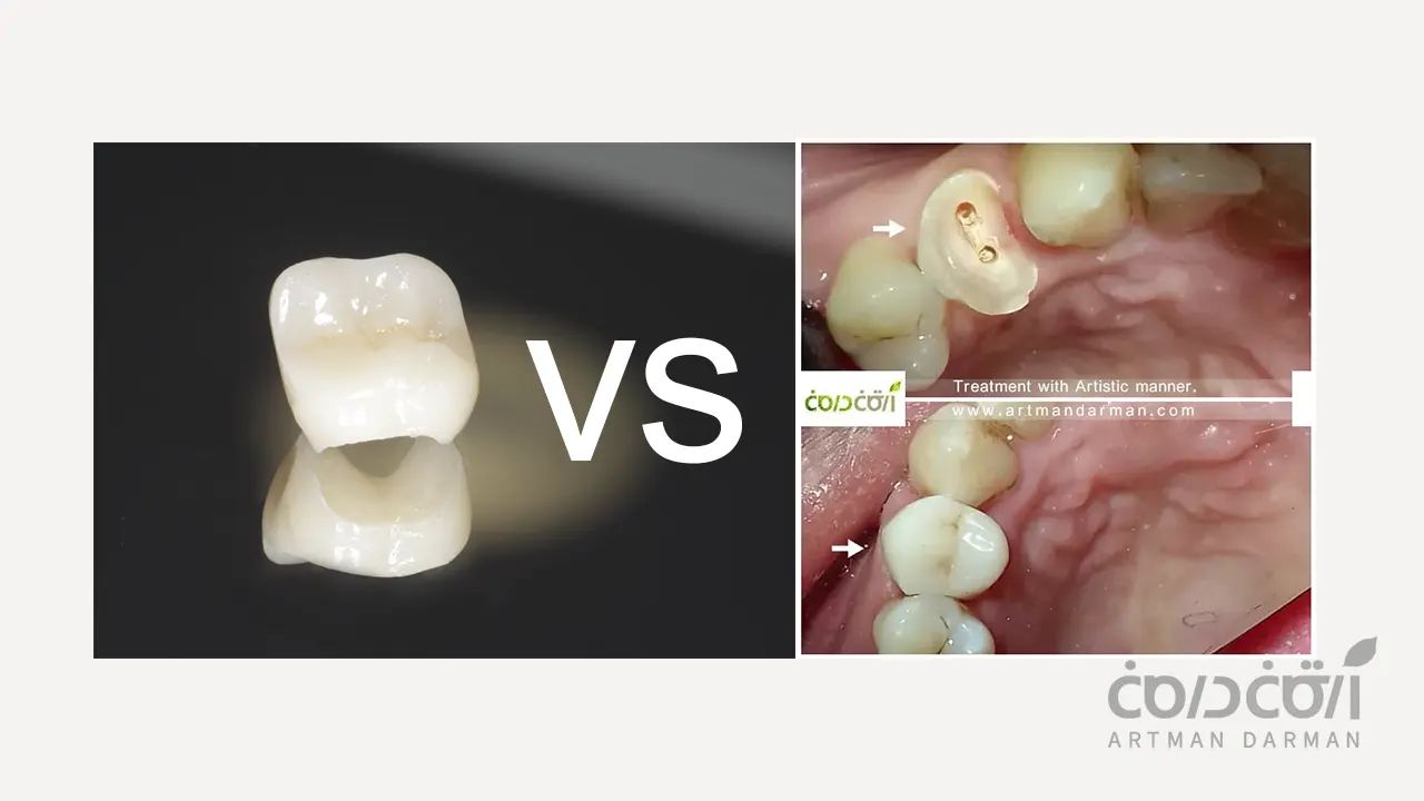 بیلداپ در مقابل روکش دندان