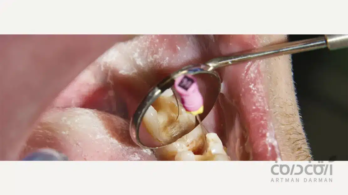 شکننده بودن دندان بعد از درمان ریشه