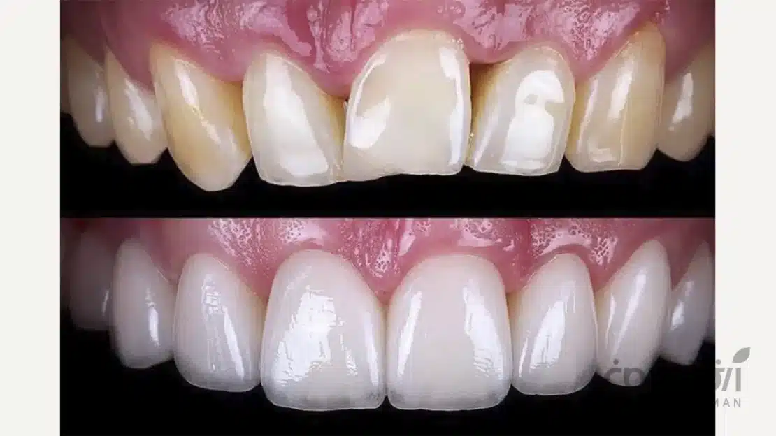 لمینت سرامیکی دندان جلو