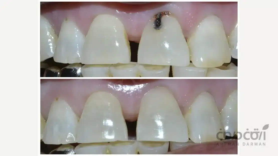 ترمیم ساده دندان جلو با کامپوزیت
