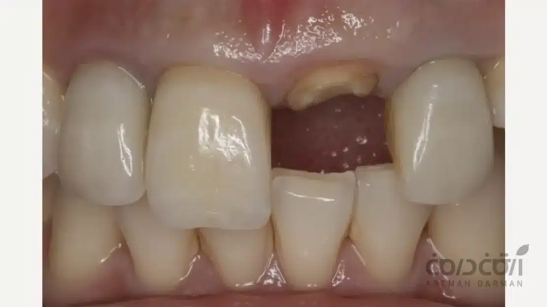 آماده سازی برای پست و کور