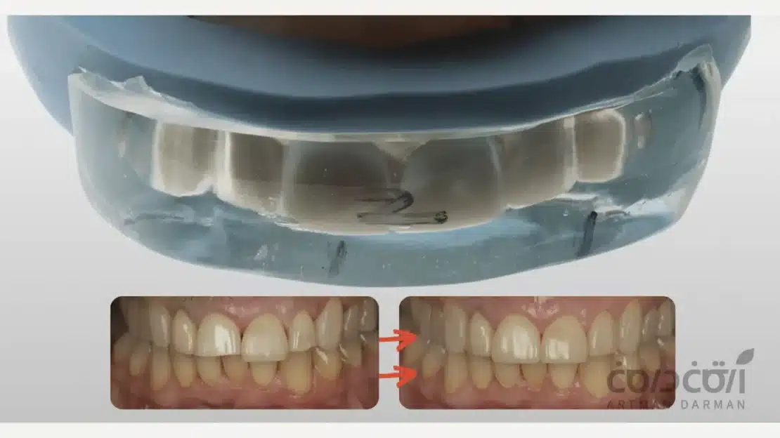 تکنیک اینجکشن مولدینگ از جدیدترین روش های ترمیم دندان