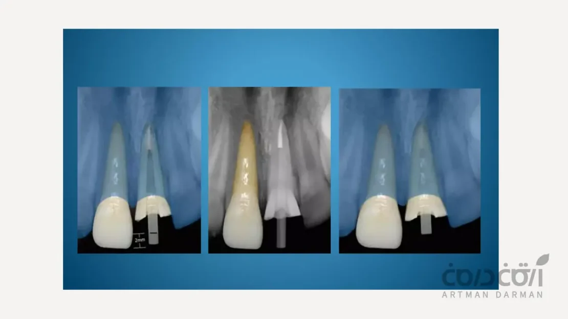 استفاده از فایبر پست در ترمیم دندان