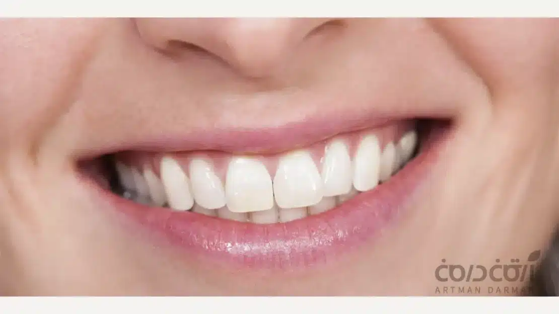 مزایای ترمی دندان با استفاده از جدیدترین روش ها