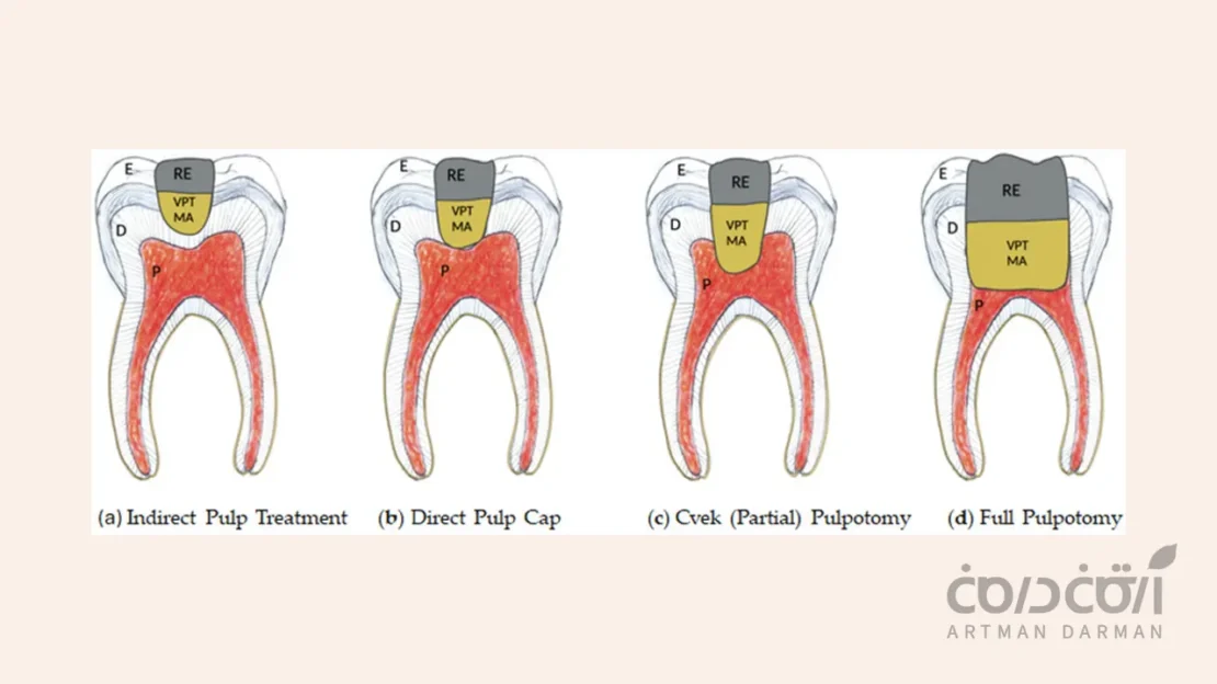 درمان عصب دندان با حداقل تهاجم