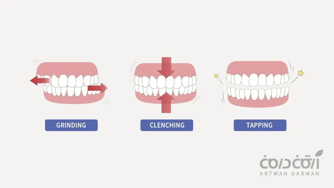 انواع دندان قروچه در انسان