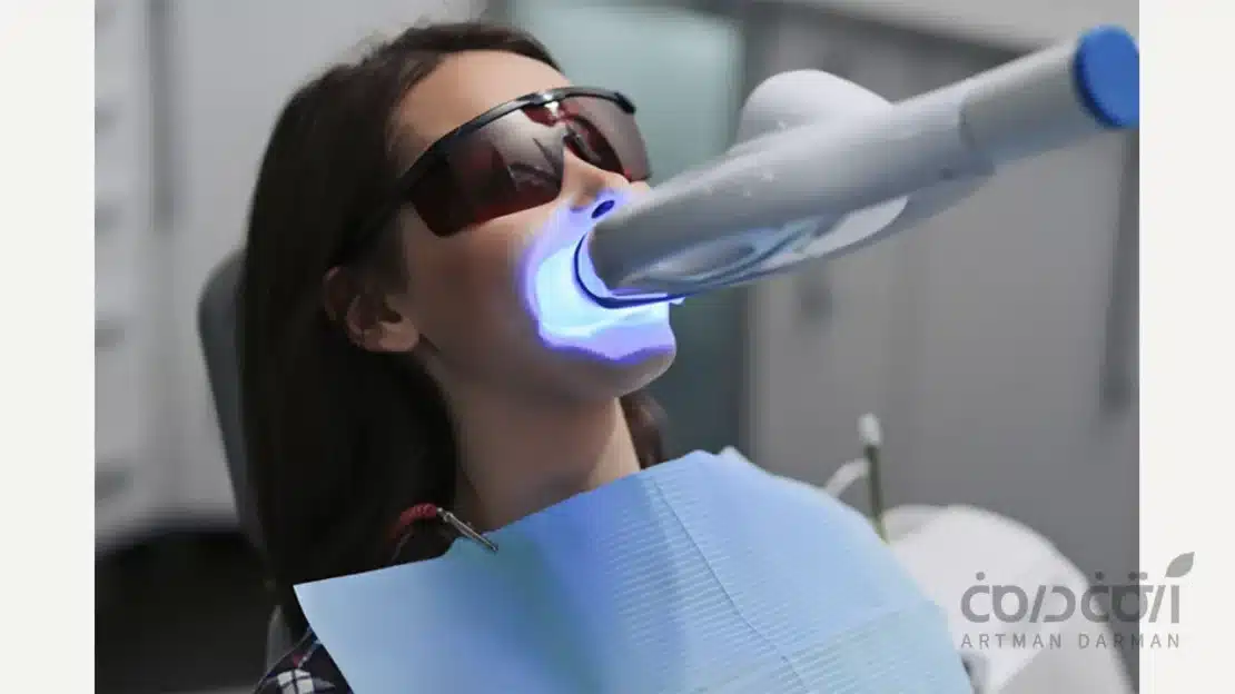 بلیچینگ دندان جایگزین لمینت دندان