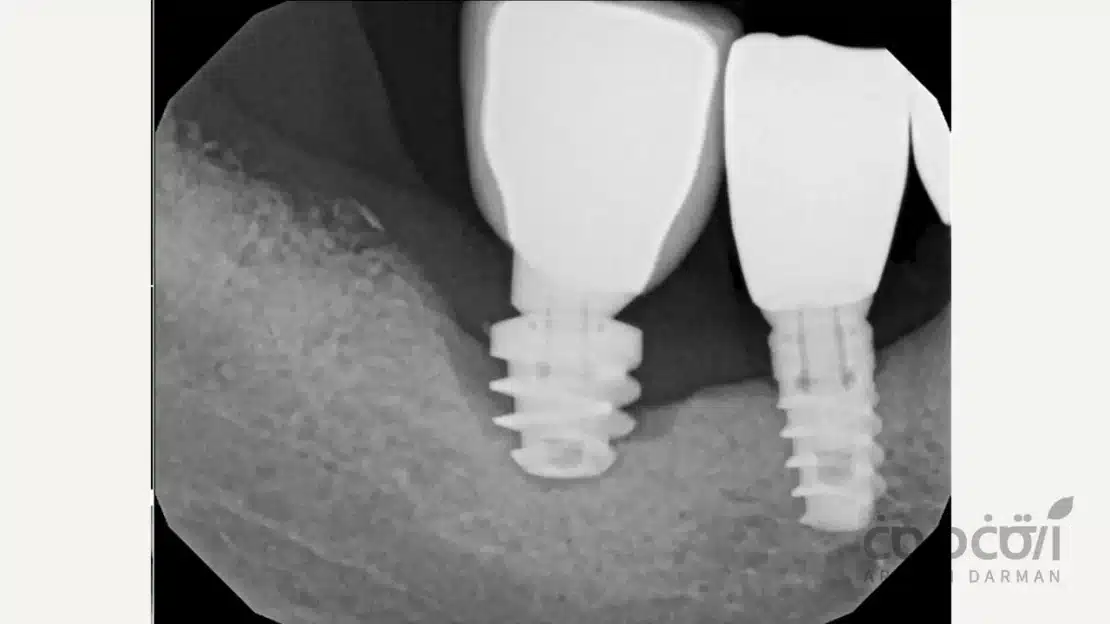 تاثیر دندان قروچه بر ایمپلنت دندان ها در قوس فکی