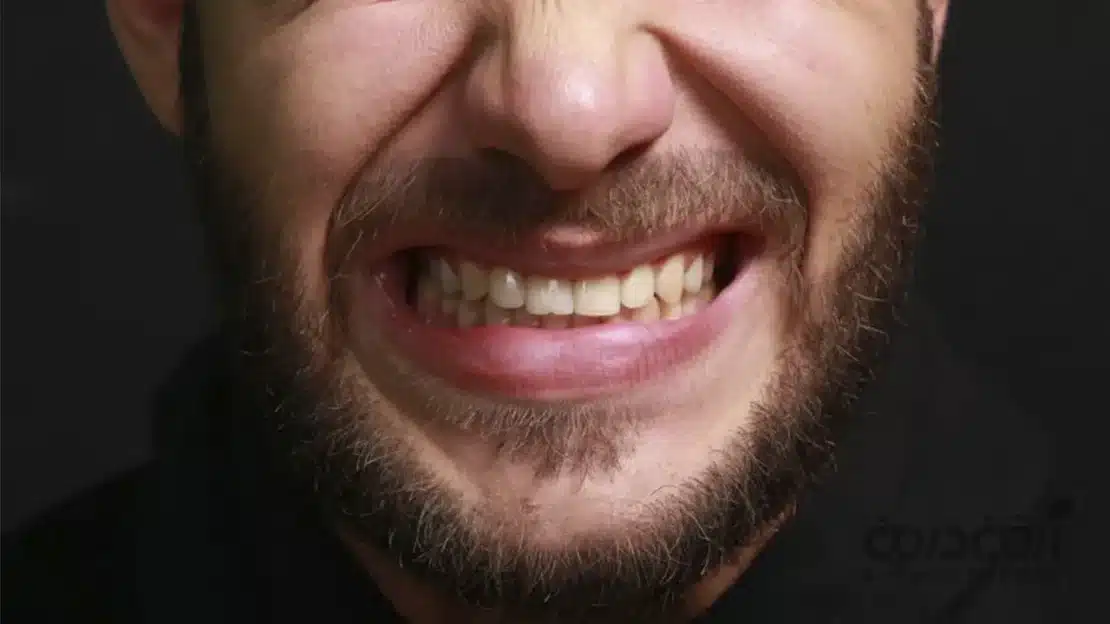 علائم دندان قروچه