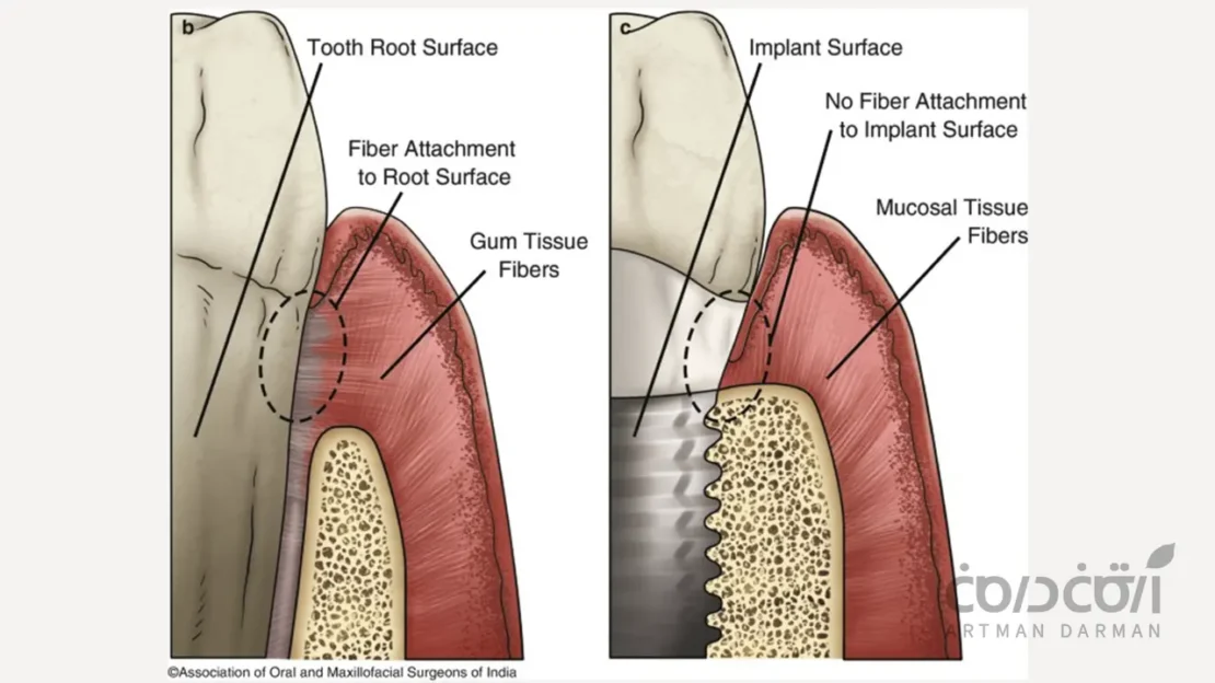 تفاوت دندان واقعی با ایمپلنت دندان