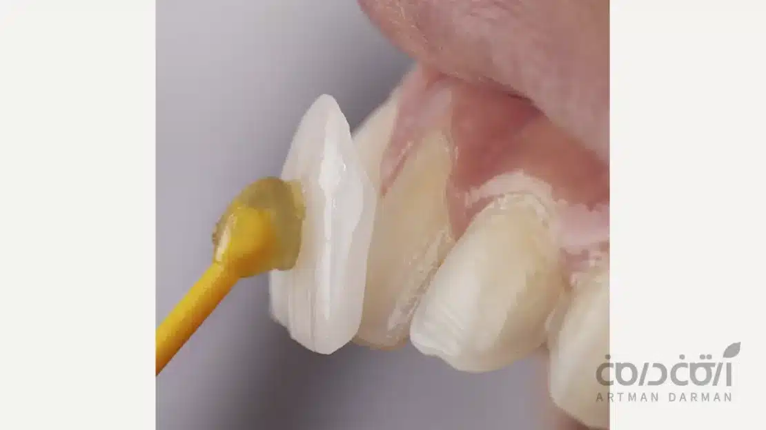 ریمو کردن لمینت دندان