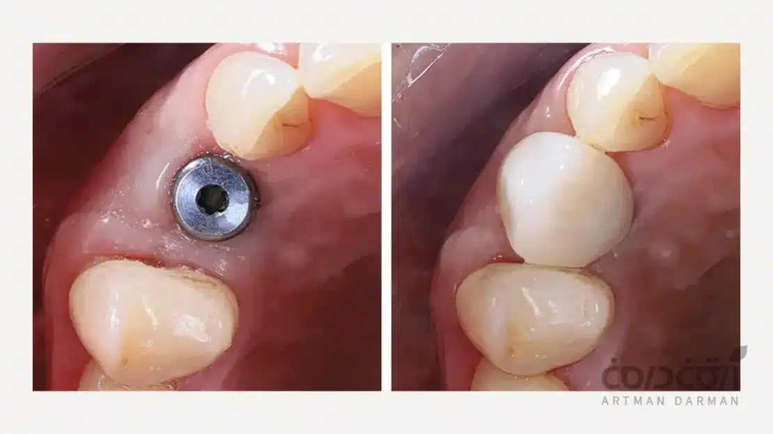 قبل و بعد از ایمپلنت دندان