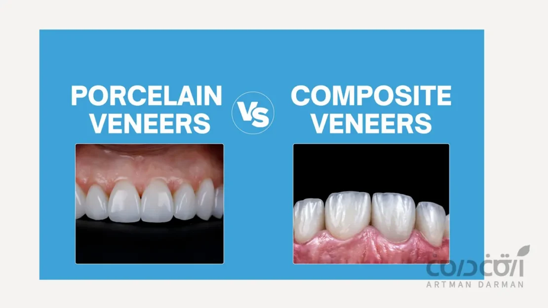 مقایسه لمینت و کامپوزیت ونیر در یک نگاه
