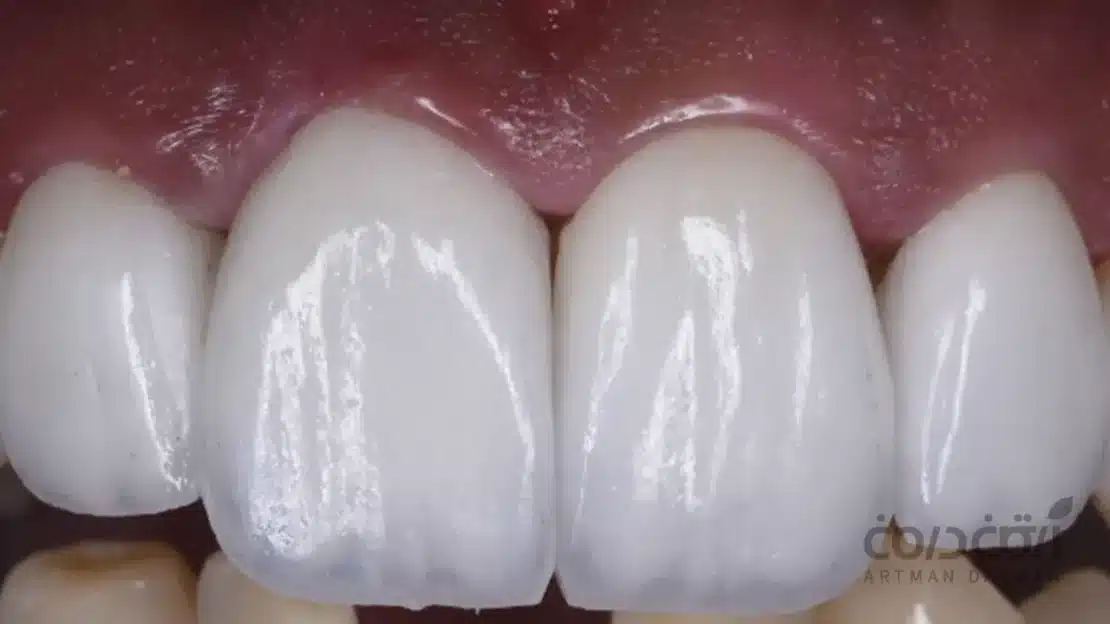 نصب مناسب لمینت دندان