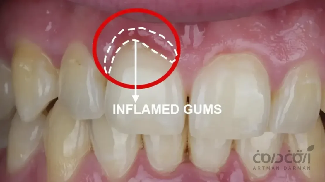 التهاب لثه ناشی از لمینت دندان
