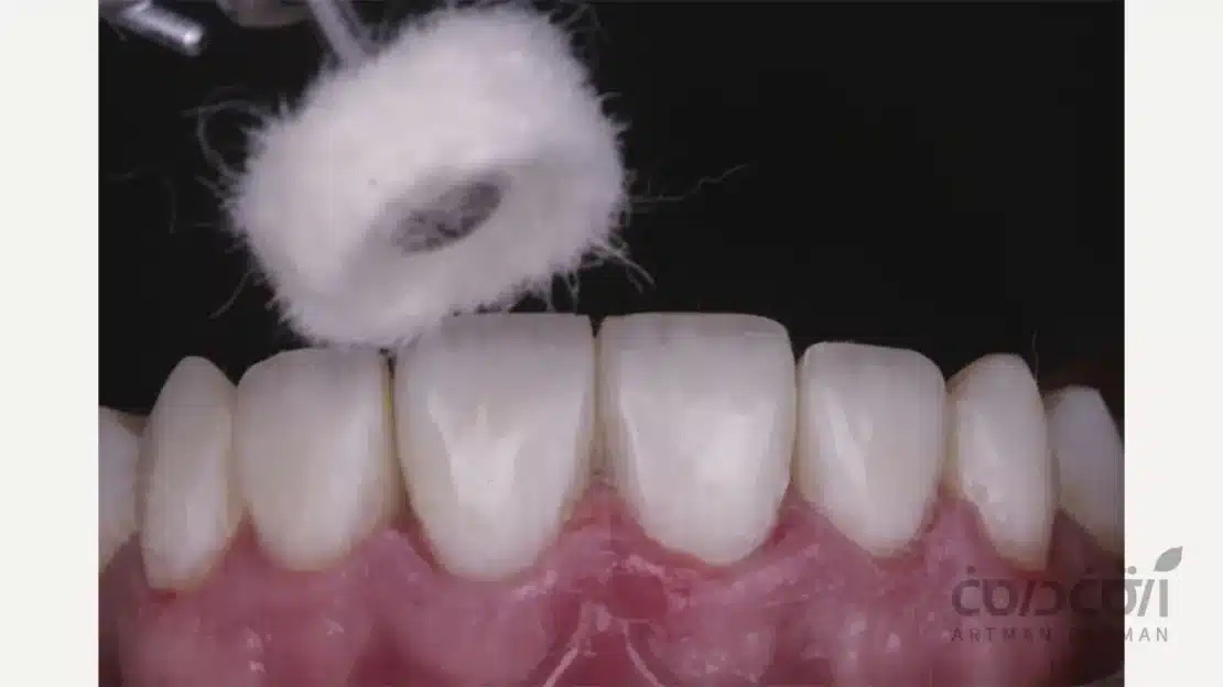 پالیش دندان