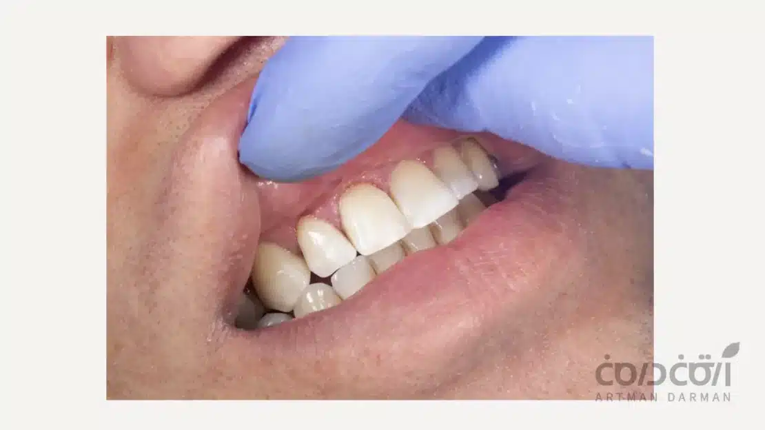 پوسیدگی زیر لمینت