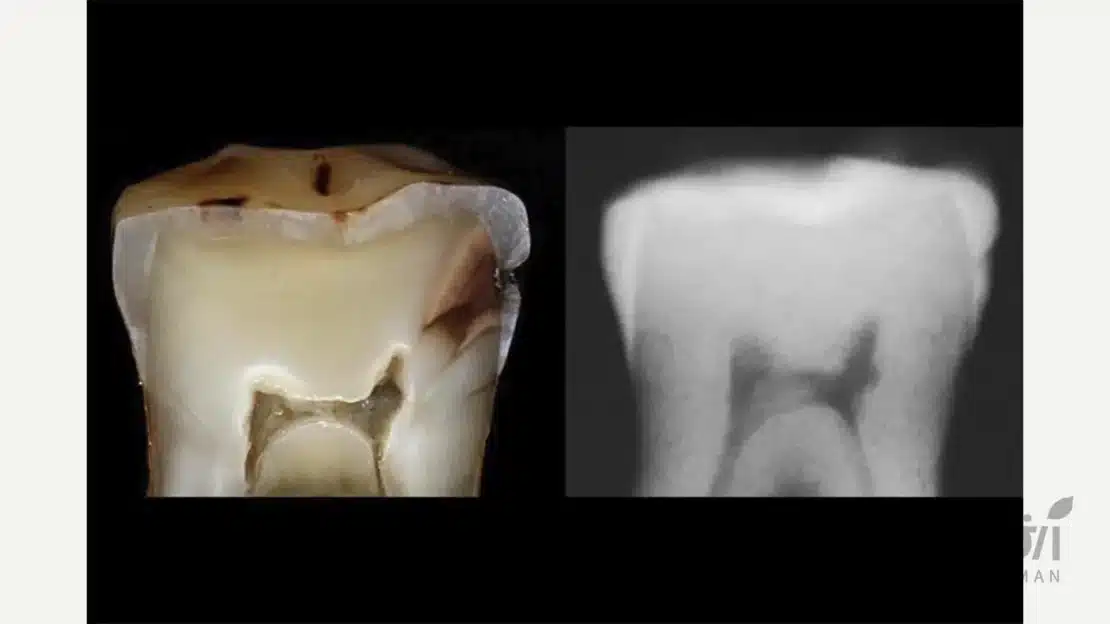 پوسیدگی زیر لمینت دندان